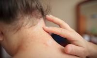 Psoriasis